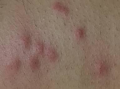 Bed bug bites on someone's skin.